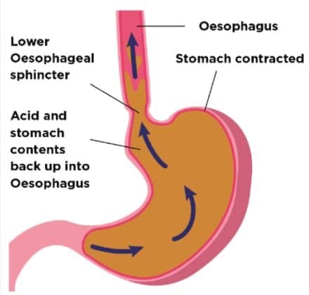 Low stomach acid symptoms infographic illustration